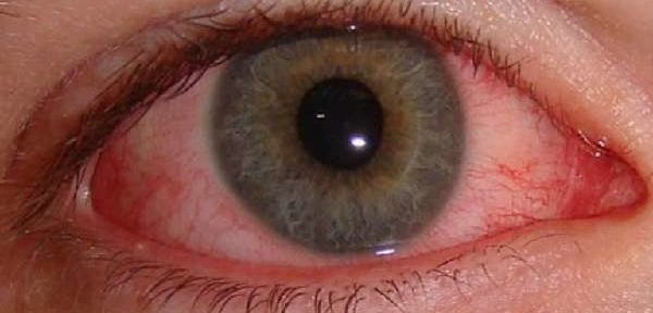 Капли после сварки для глаз — чем можно закапать, средство от боли и можно ли применять Новокаин, глазные капли для лечения